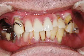 インプラント治療例1 治療前