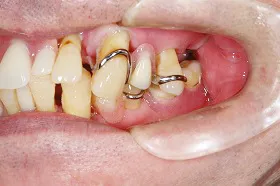 インプラント治療例1 治療前