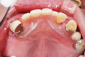インプラント治療例1 治療前