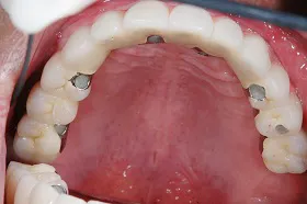 インプラント治療例1 治療後