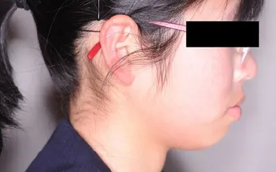 矯正治療例1 治療前