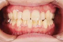 矯正治療例5 治療後