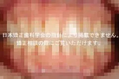 矯正治療例7 治療前