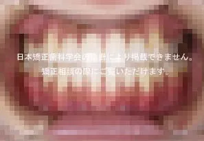 矯正治療例7 治療後