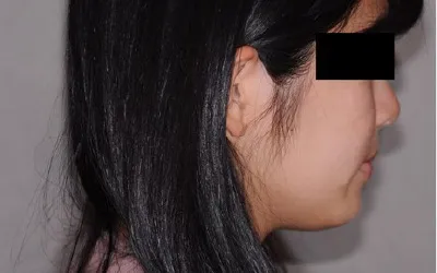 矯正治療例1 治療後