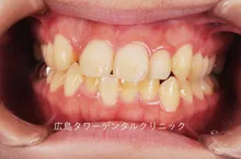 矯正治療例5 治療前