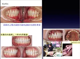 歯周組織再生治療例3 治療の写真