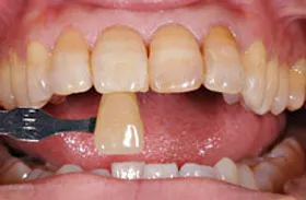 ホワイトニング治療例1 治療前