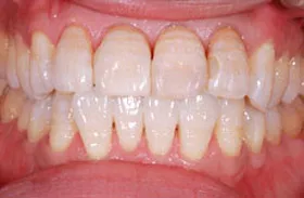 ホワイトニング治療例1 治療後