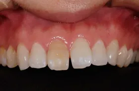 ホワイトニング治療例2 治療前