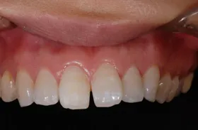 ホワイトニング治療例2 治療後