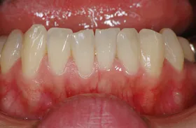 ホワイトニング治療例3 治療前