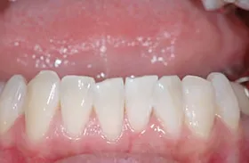 ホワイトニング治療例3 治療後