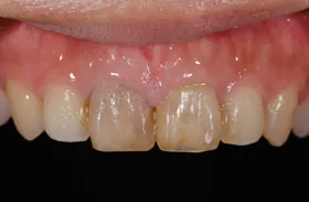ホワイトニング治療例4 治療前
