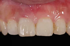 ホワイトニング治療例4 治療後
